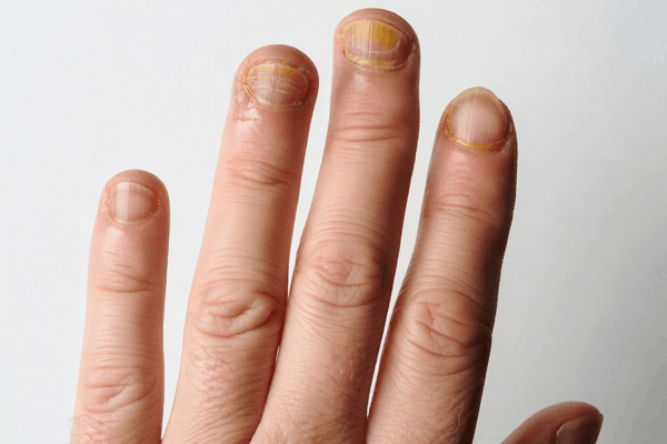 Натуральные товары компании Vivasan, Швейцария в категории Грибковые заболевания.