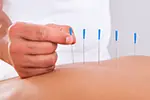 Акупунктура: користь чи шкода?
